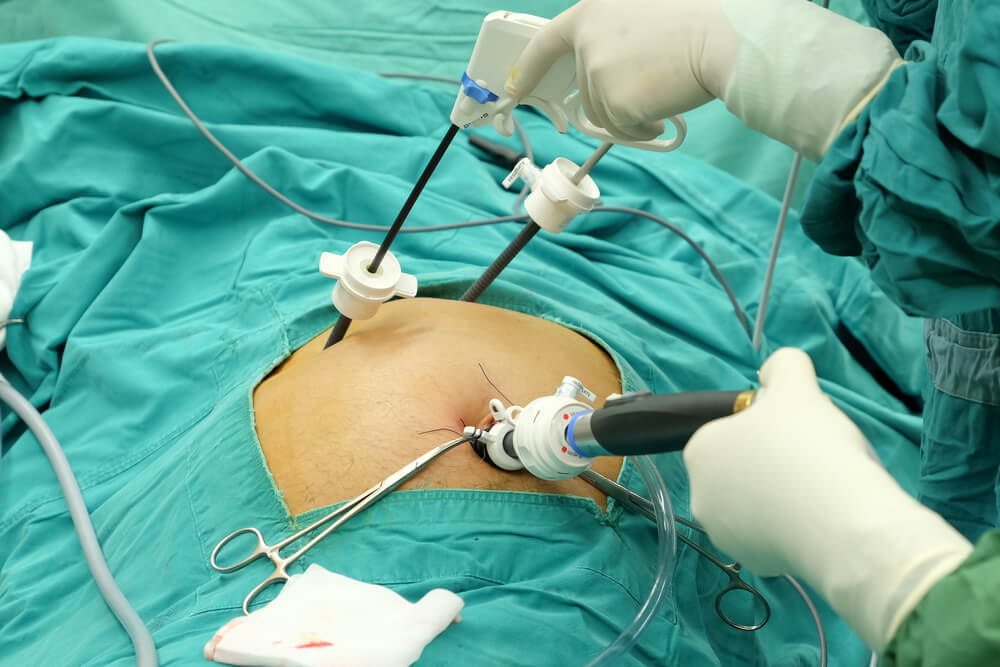 Laparoscopic Cholecystectomy