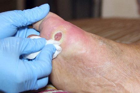 Diabetic foot
