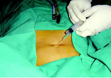 Diagnostic Laparoscopy at Chandak Hospital