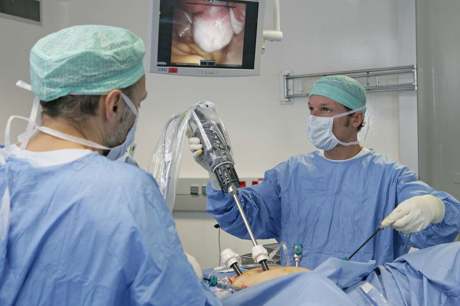 Uterine prolapse